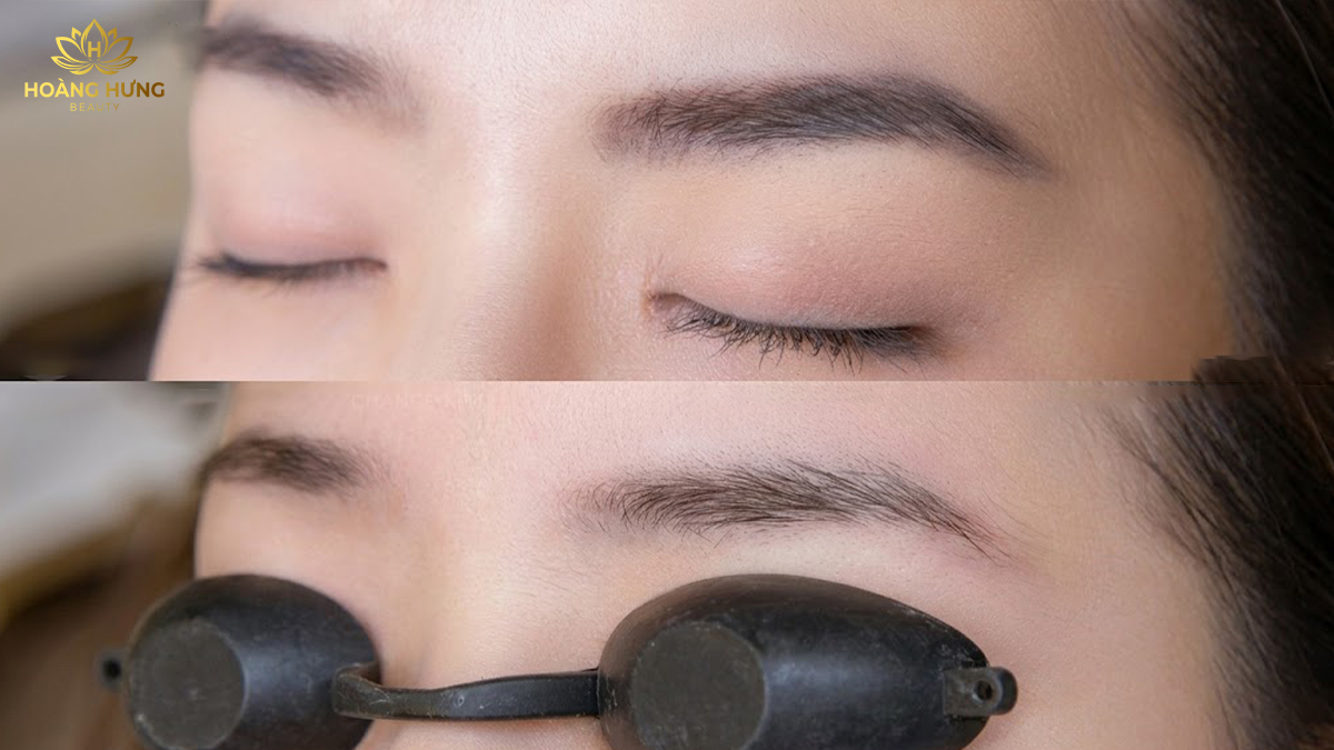 Trước và sau khi xóa xăm chân mày