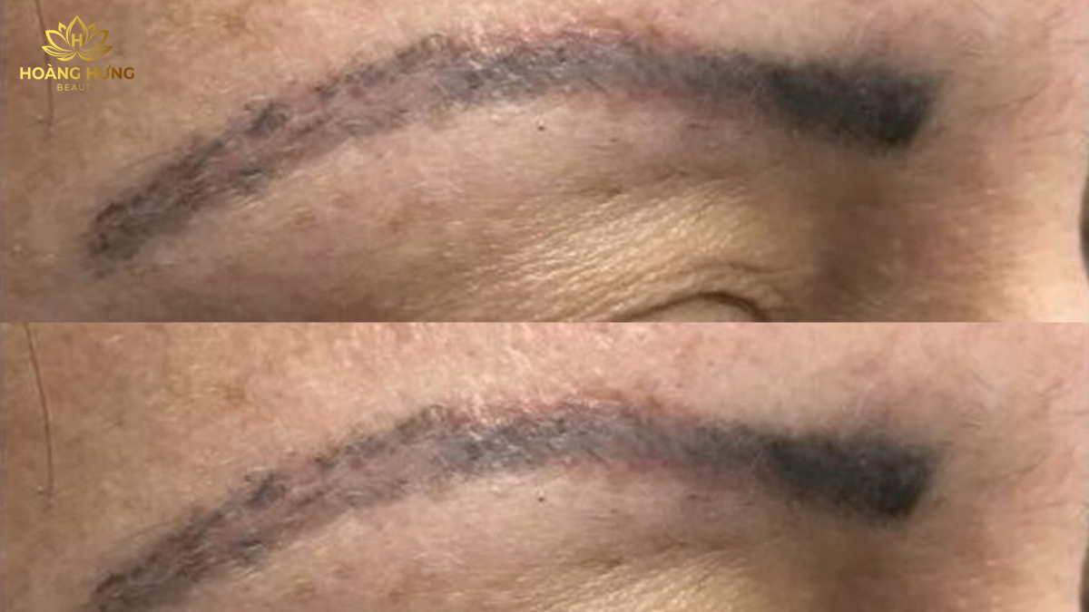 Dáng mày và kiểu xăm bị lỗi cần nên chọn phương pháp xóa xăm chân mày