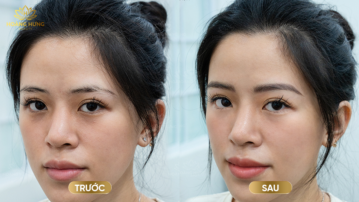 Kết quả trước và sau khi sửa chân mày bị hư tự nhiên