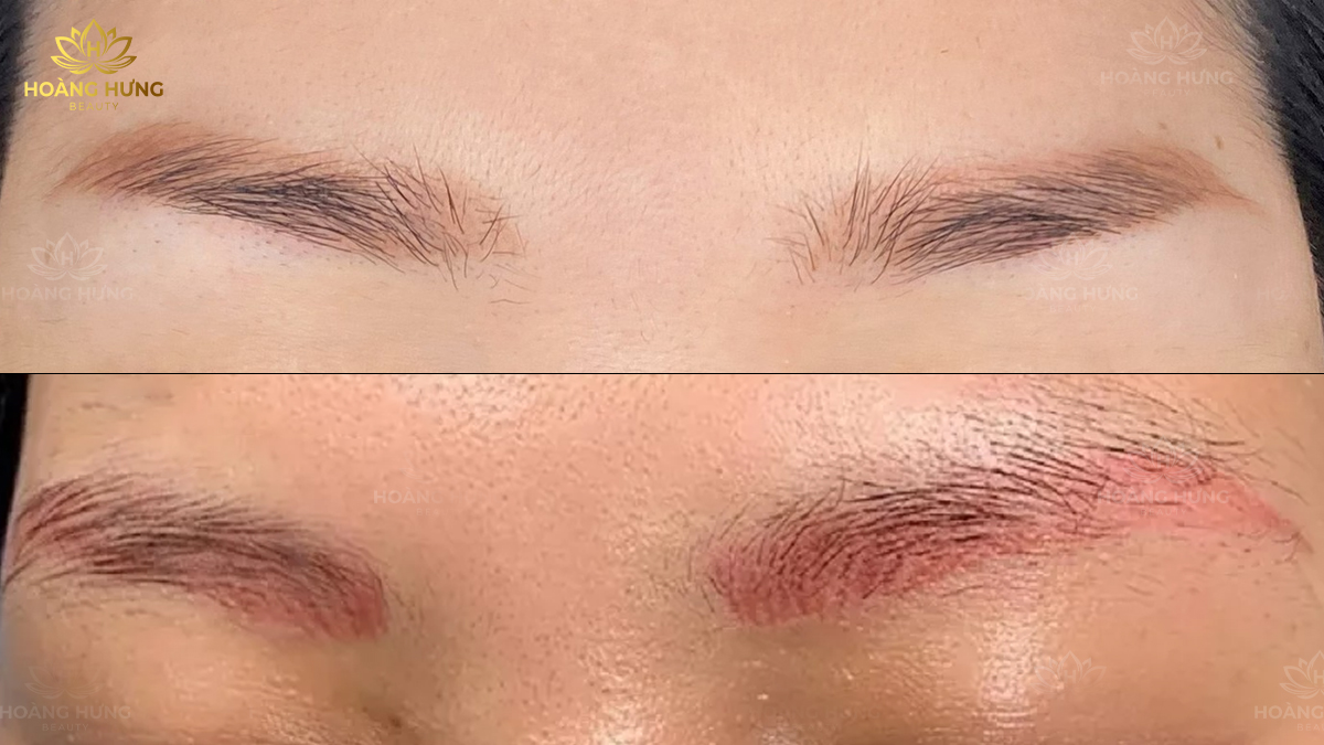 Sửa chân mày bị hư do nền mày cũ bị trổ đỏ