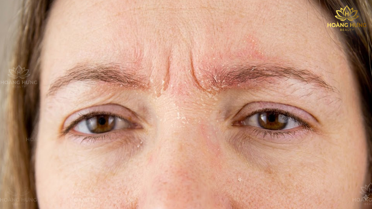 Xăm Chân Mày Có Đau Không? 5 Yếu Tố Ảnh Hưởng Đến Mức Độ Đau 4 Vùng da nhạy cảm bị ngứa rát trước khi phun xăm chân mày