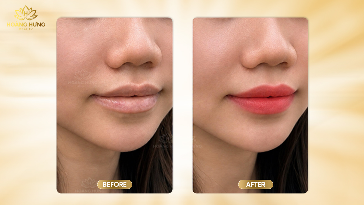 Phun môi collagen cho môi thâm sau khi màu ổn định