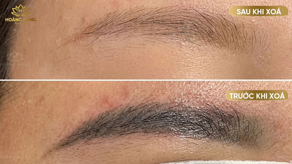 Trước và sau khi xóa xăm chân mày trổ đỏ, trổ xanh tại Hoàng Hưng Beauty